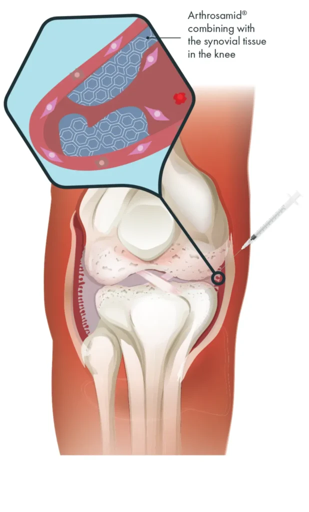 arthrosamid treatment